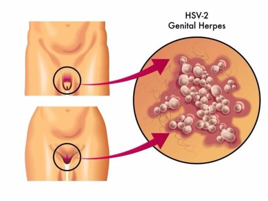 Genital Herpes
