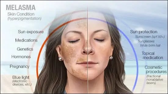 How to Treat Hyperpigmentation Disorders Such as Melasma and Dark Spots