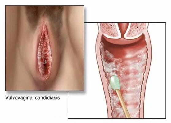 What is Vaginal Yeast Infection and How to Treat it With Clotrimazole Gel